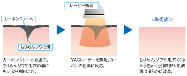 レーザーの効果
