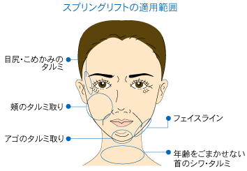 スプリングリフトの適用範囲