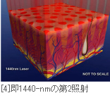[4]即1440-nmの第2照射